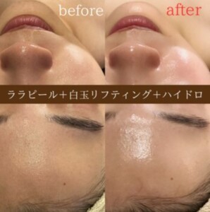 beforeafter
